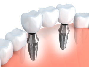 Dental implant