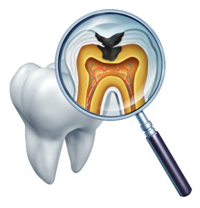 Tooth Cavity