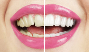 Tooth Discoloration